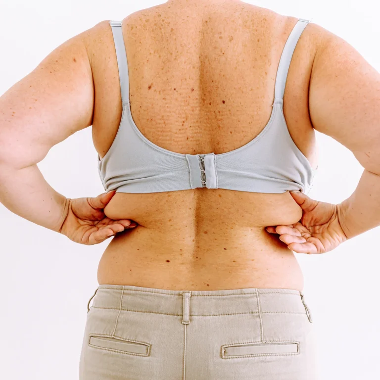 Posterior clinical assessment of subcutaneous lipodystrophy for the Ideal Candidate for Back Liposuction in Dubai.