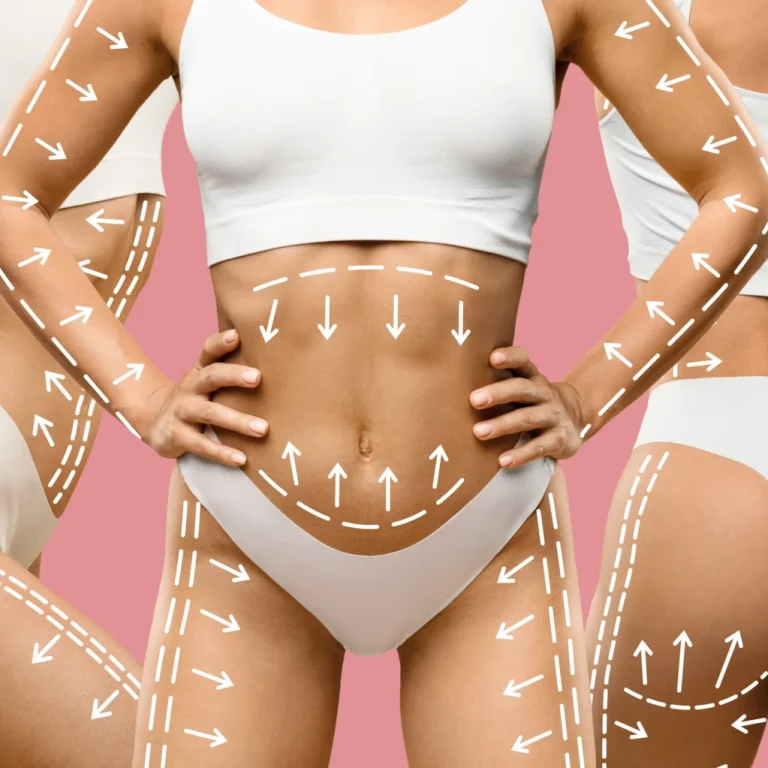 A detailed composite clinical graphic displaying a side, front, and back view of a woman's torso in white underwear against a solid pink background, with white vector arrows and dashed lines mapping out circumferential recovery zones for Full Body Liposuction In Dubai.